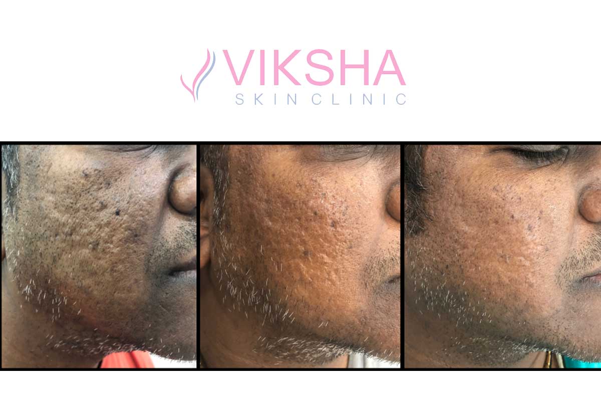Viksha Skin Clinic In Ahmedabad